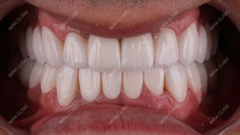healthy gums